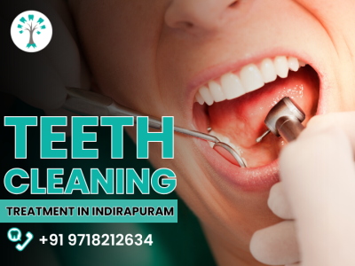 Teeth Cleaning Treatment in Indirapuram
